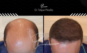 Dr. Pittella • Norwood 7, Large head, Poor donor, Thin Hair: Come and see (WET)