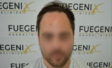 Dr. Munib Ahmad - 2540g - The Hairline That You Dream Of - FueGenix - The Netherlands