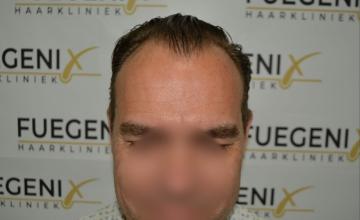 Dr. Munib Ahmad - 2440g - Hairline Artistry At It's Best - Thin Brown Hair - FueGenix - The Netherlands