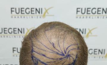 Dr. Munib Ahmad - 2724g - Big Crown - 6 Months Result - FueGenix - The Netherlands