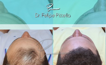 Dr. Pittella • Norwood 6, Large head, Good donor, Wavy thick Hair: Favorable Case