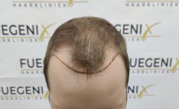 Dr. Munib Ahmad - 2260g - Hairline - FueGenix - The Netherlands