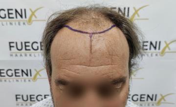 Dr. Munib Ahmad - 2360g- Hairline - Gray Hair - FueGenix - The Netherlands