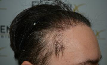 Dr. Munib Ahmad - Failed temple/hairline repaired in one sitting (Plugs, scarring, kinky hairs) - 2050g - FueGenix - The Netherlands