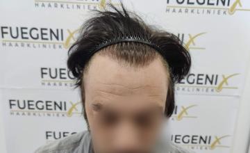 Dr. Munib Ahmad - 2060g - From Failed Hair Transplant To Shah Rukh Khan - Straight Brown Hair - FueGenix - The Netherlands