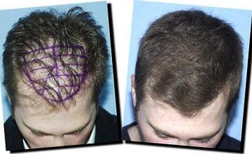 Hair restoration procedure results