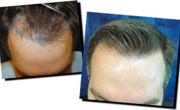 Hair restoration procedure results