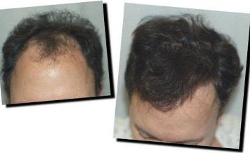 Hair restoration procedure results