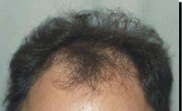 Hair restoration procedure results