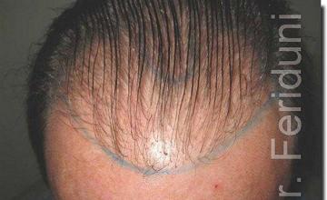 Hair restoration procedure results