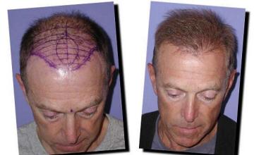 Hair restoration procedure results