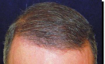 Hair restoration procedure results