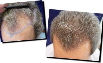 Hair restoration procedure results