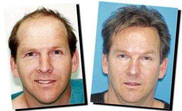 Hair restoration procedure results