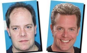 Hair restoration procedure results