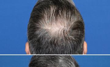 Before and After