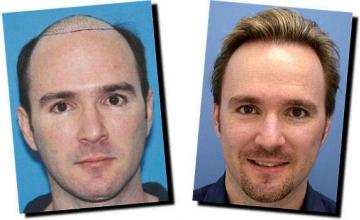 Hair restoration procedure results