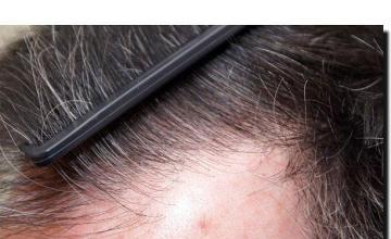 Hair restoration procedure results