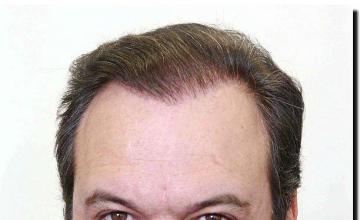 Hair restoration procedure results