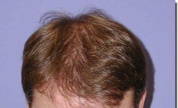 Hair restoration procedure results