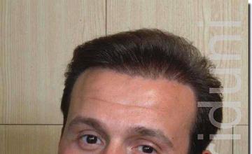 Hair restoration procedure results