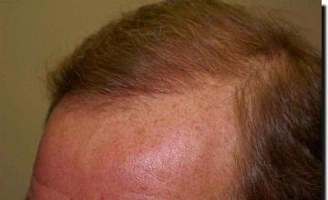 Hair restoration procedure results