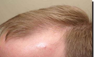 Hair restoration procedure results