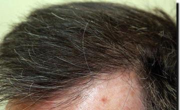 Hair restoration procedure results