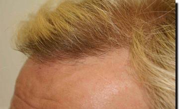 Hair restoration procedure results