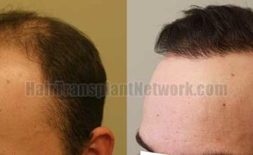 Left view before and after hair transplant surgery