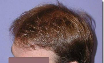 Hair restoration procedure results