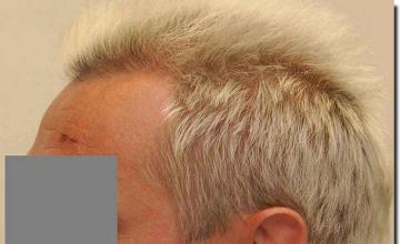 Hair restoration procedure results