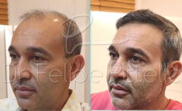 Left view before and after hair transplant surgery