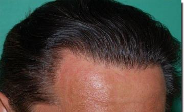 Hair restoration procedure results