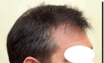 Hair restoration procedure results