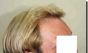 Hair restoration procedure results