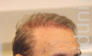 Hair restoration procedure results