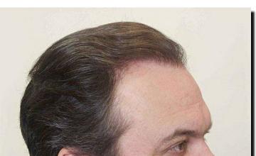 Hair restoration procedure results