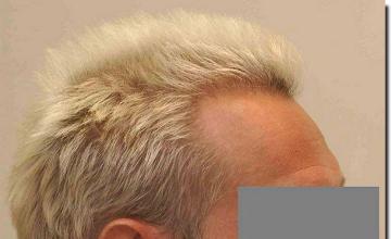 Hair restoration procedure results