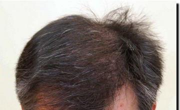 Hair restoration procedure results