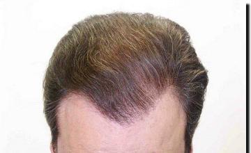 Hair restoration procedure results