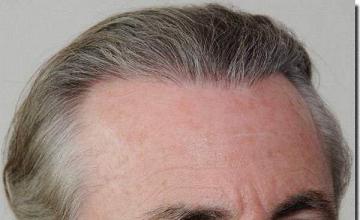 Hair restoration procedure results