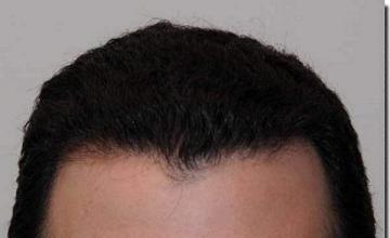 Hair restoration procedure results