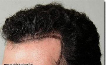 Hair restoration procedure results