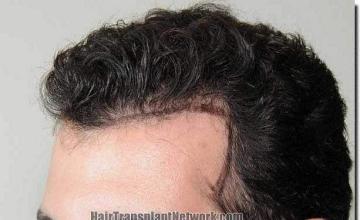 Hair restoration procedure results