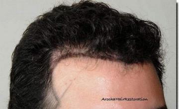 Hair restoration procedure results