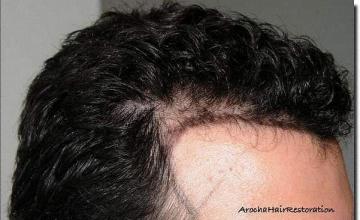 Hair restoration procedure results