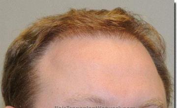 Hair restoration procedure results