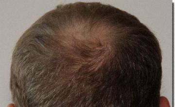 Hair restoration procedure results