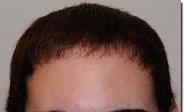 Hair restoration procedure results